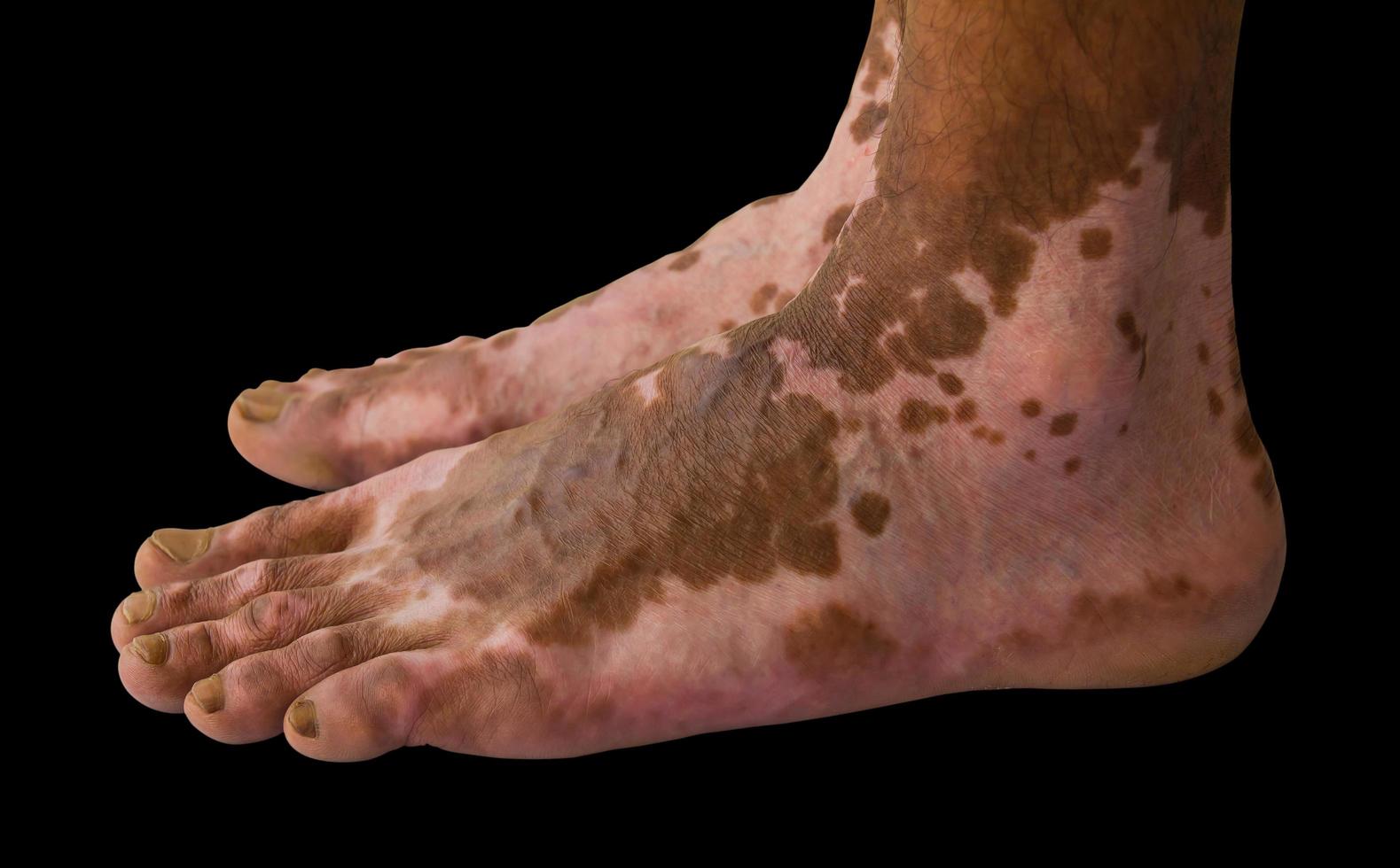 Burns Foot Woman photo