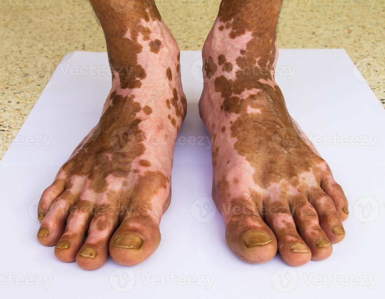 Scar bare feet photo