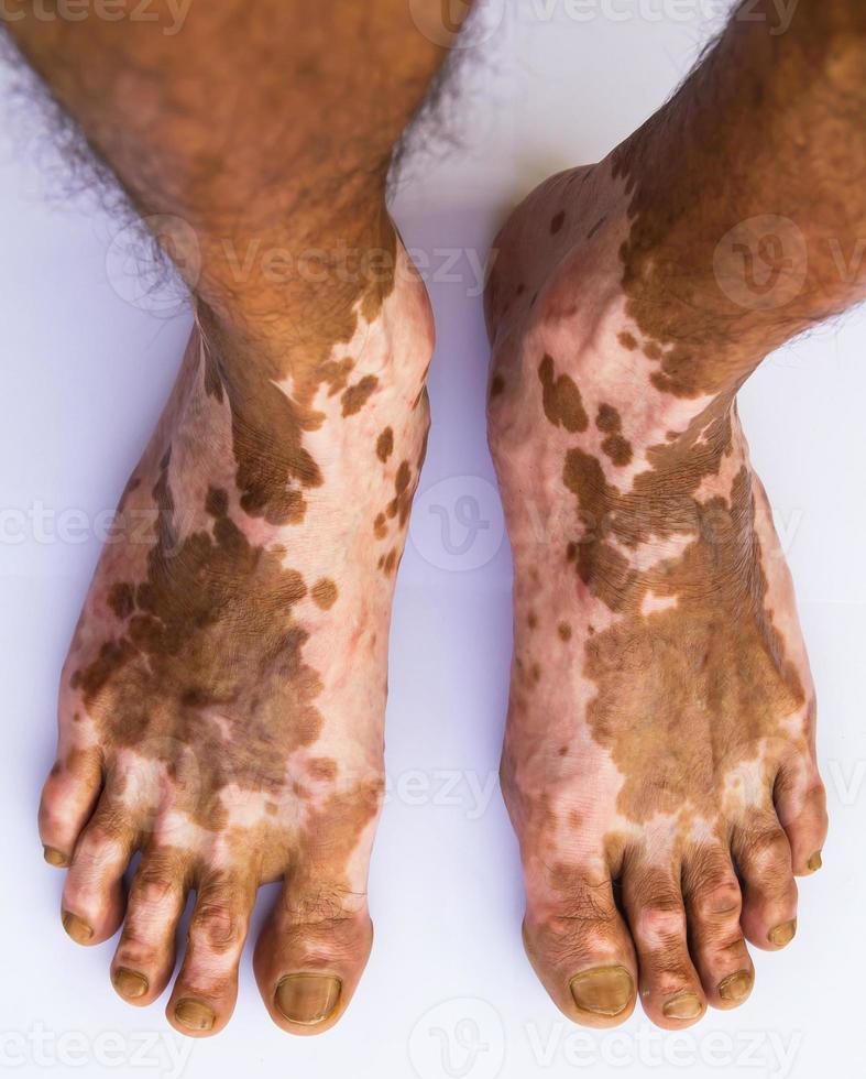 Scar bare feet photo