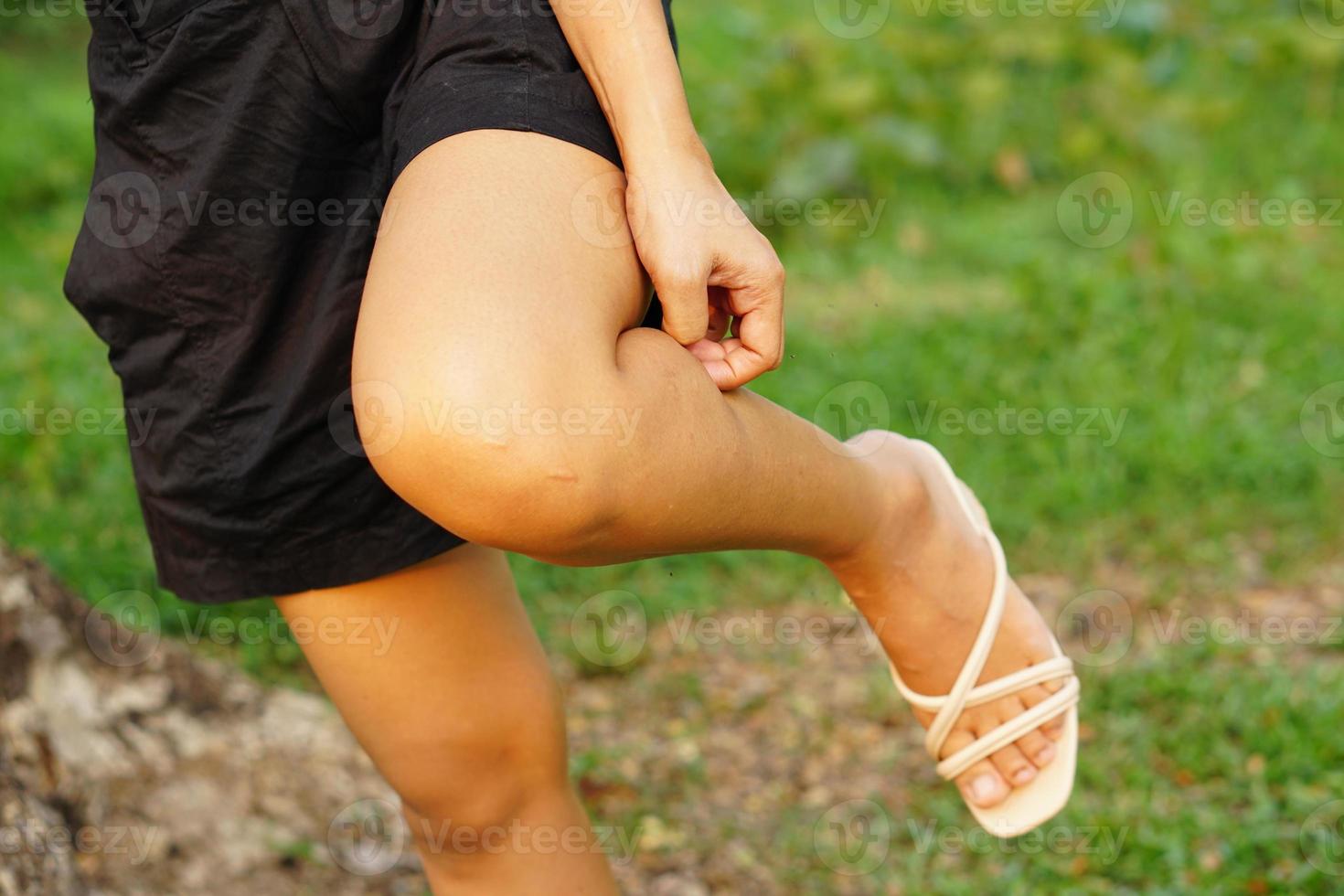 Woman wearing shorts itchy legs Scratch with your hands to relieve itching. photo