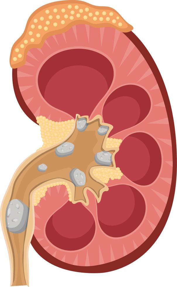 cálculos renales ilustración vectorial plana vector