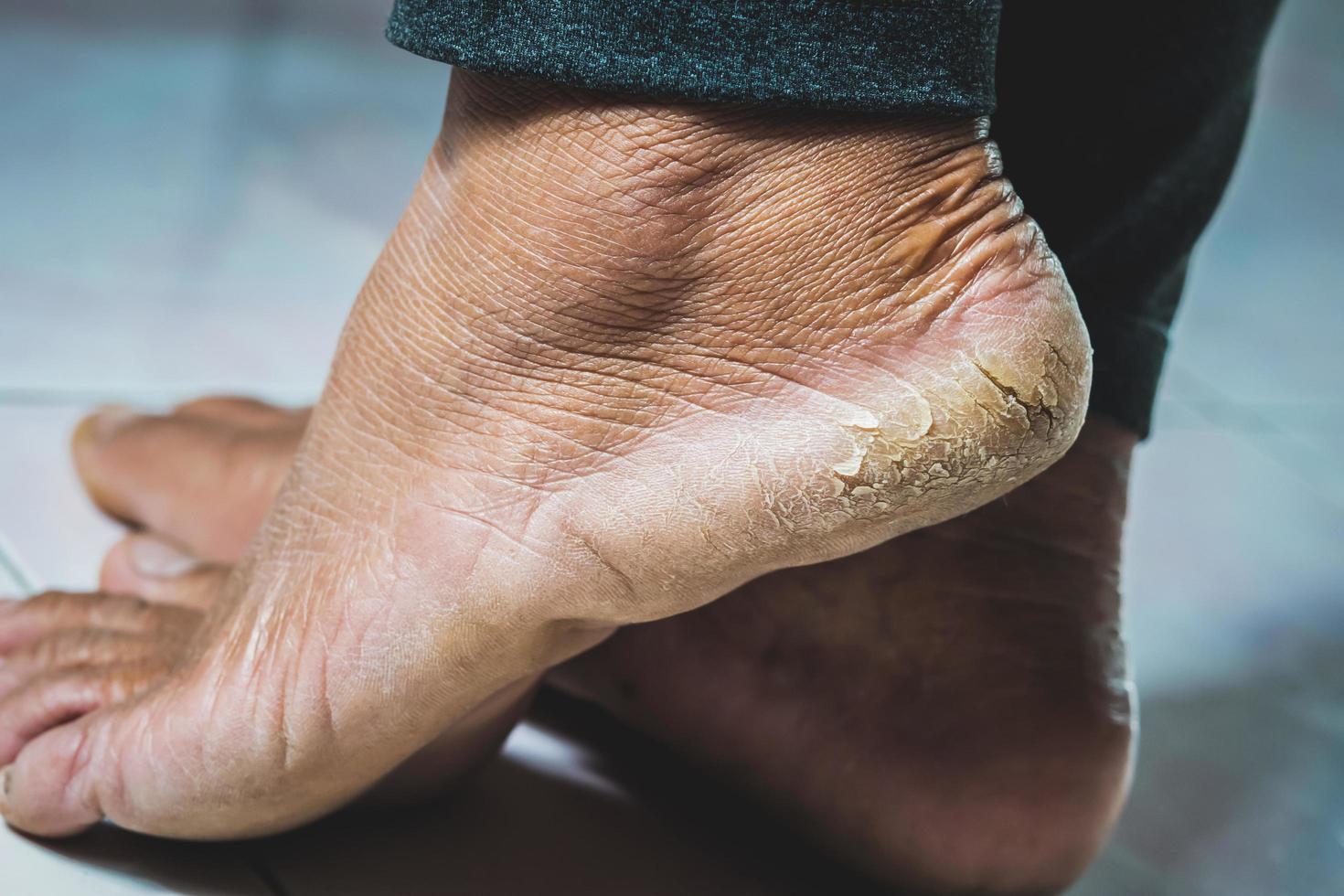 close up heel feet is cracks photo