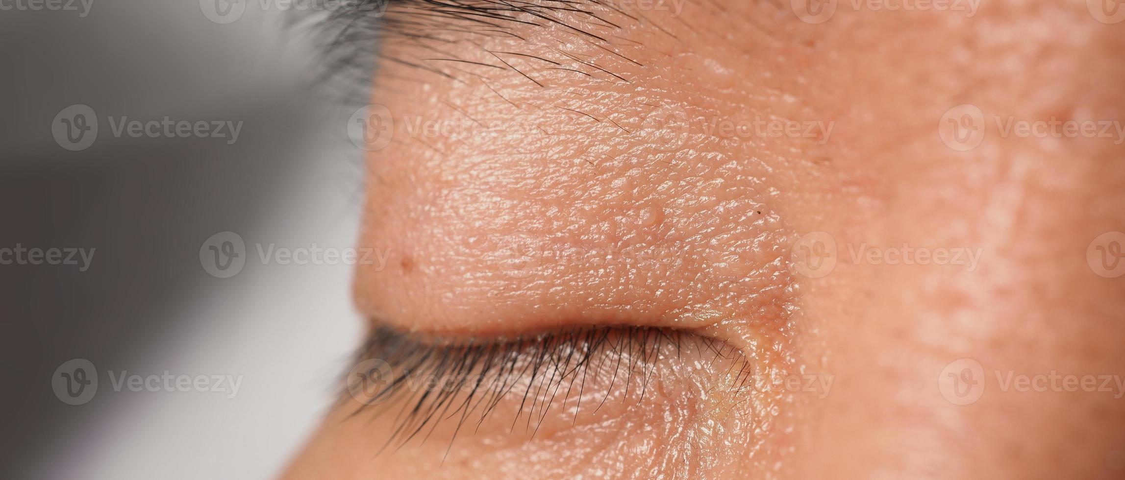 Eliminación de piel de verrugas. toma macro de verrugas cerca del ojo en la cara. foto