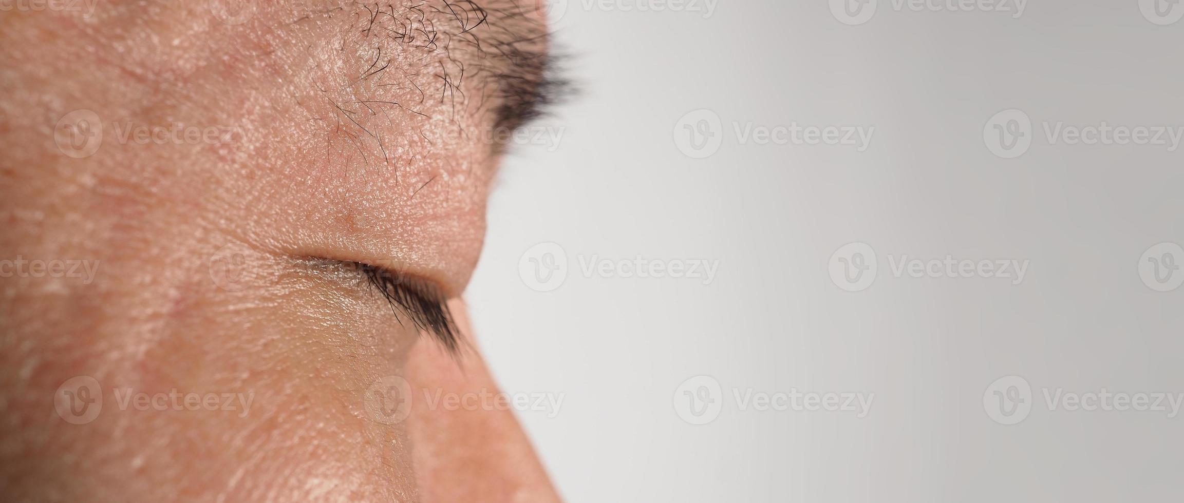 Wart skin removal. Macro shot of warts near eye on face. photo