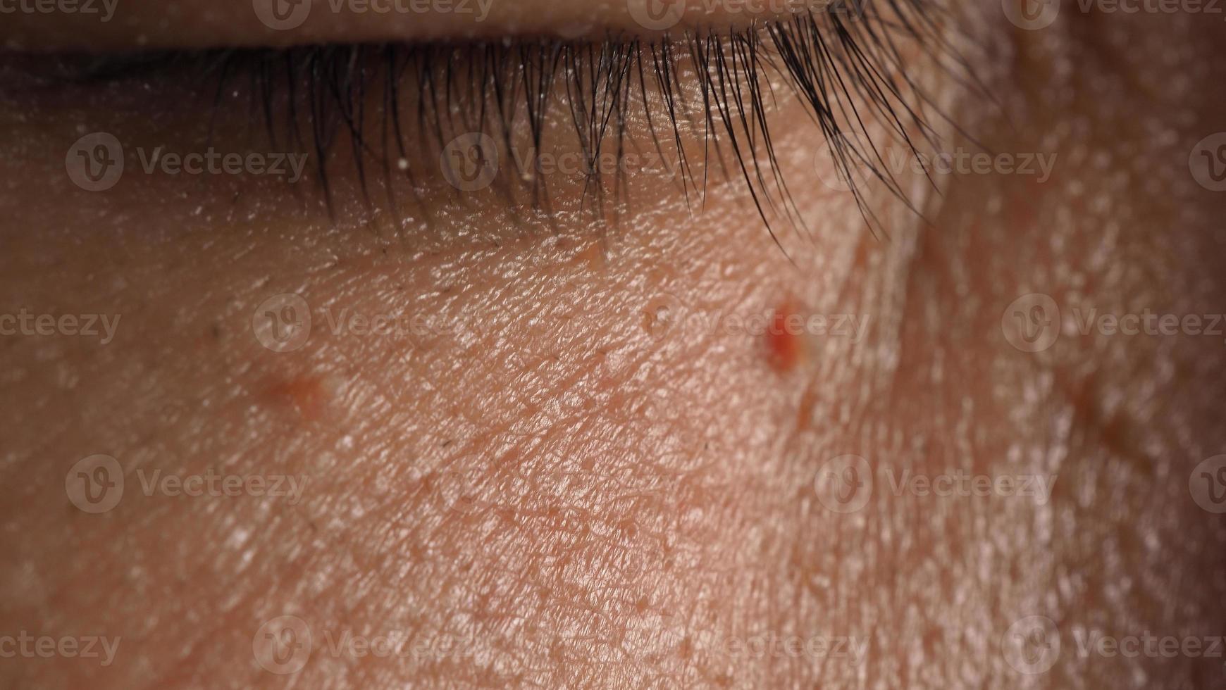 Wart skin removal. Macro shot of warts near eye on face. photo