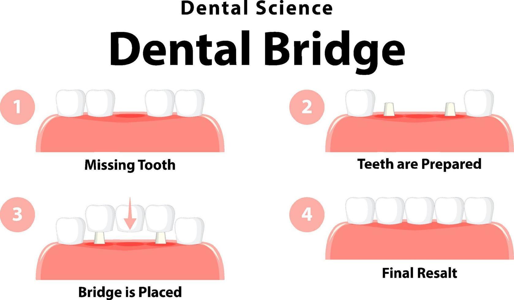 infografía de humano en puente dental sobre fondo blanco vector