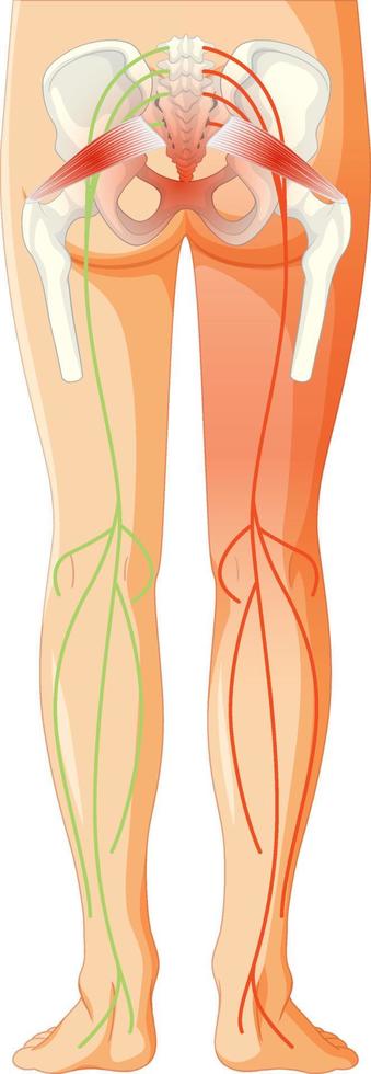 espalda baja que sufre de espondilitis anquilosante vector