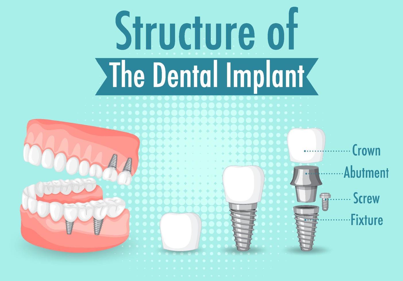 Infographic of human in structure of the dental implant vector