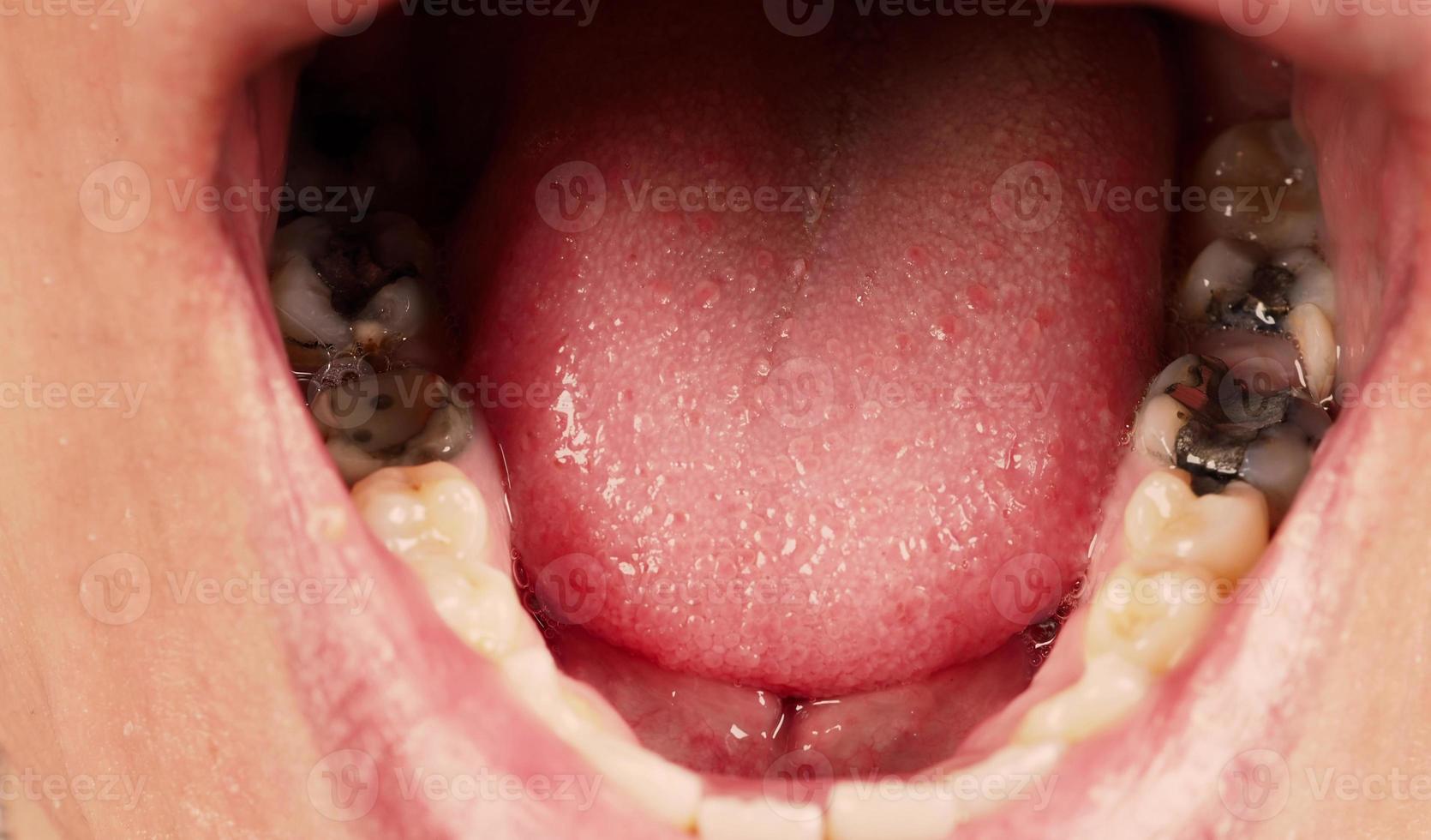 Decayed tooth root canal treatment. Tooth or teeth decay of lower molar. photo