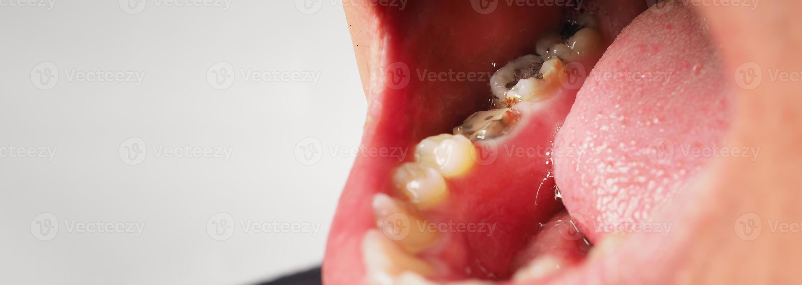 Decayed tooth root canal treatment. Tooth or teeth decay of lower molar. photo