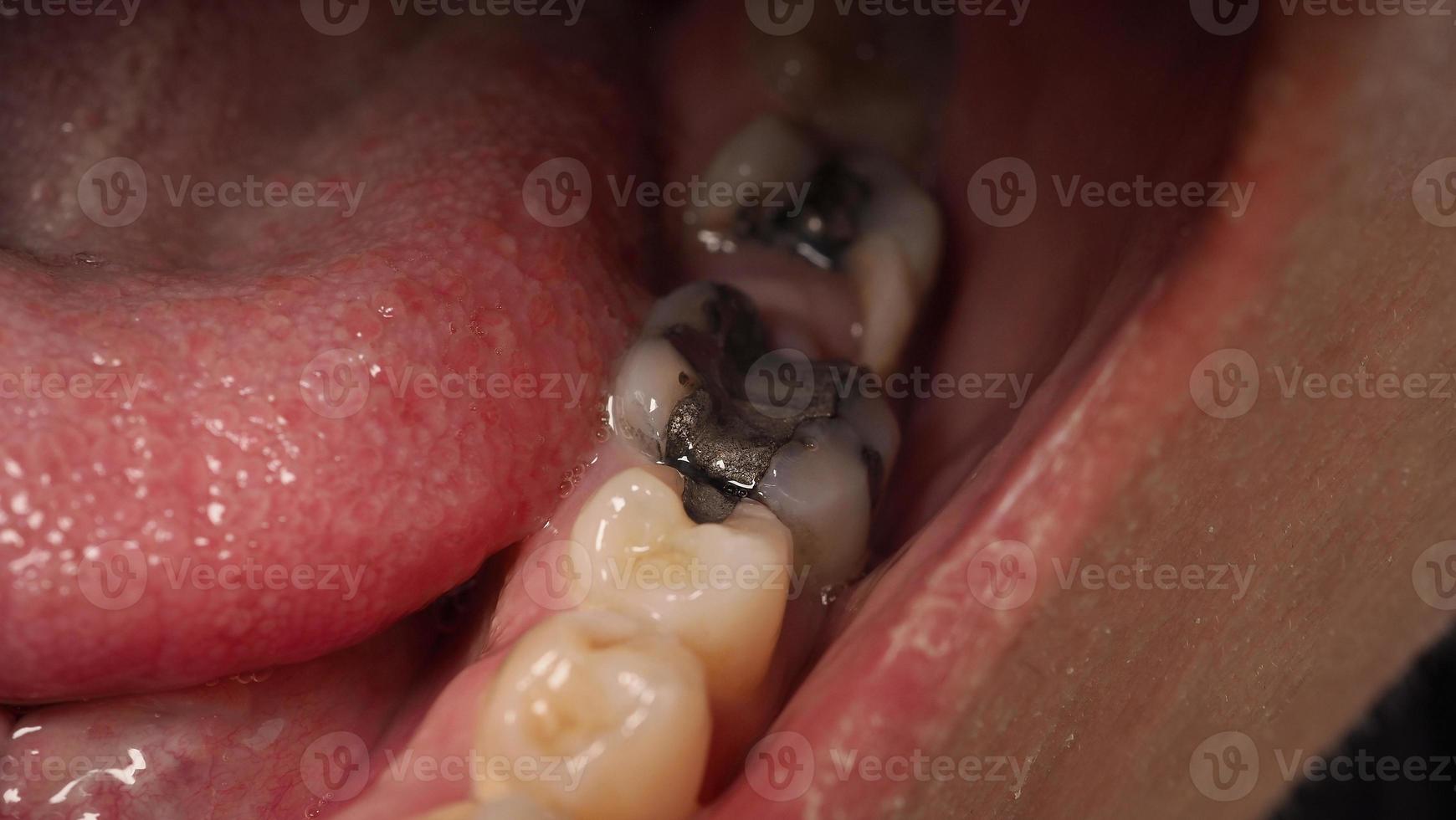 Tratamiento de conductos radiculares de dientes cariados. Diente o caries dental del molar inferior. foto