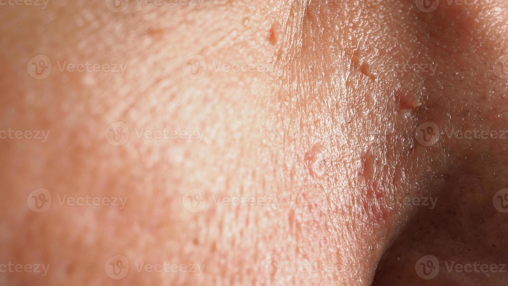 Wart skin removal. Macro shot of warts near eye on face. photo