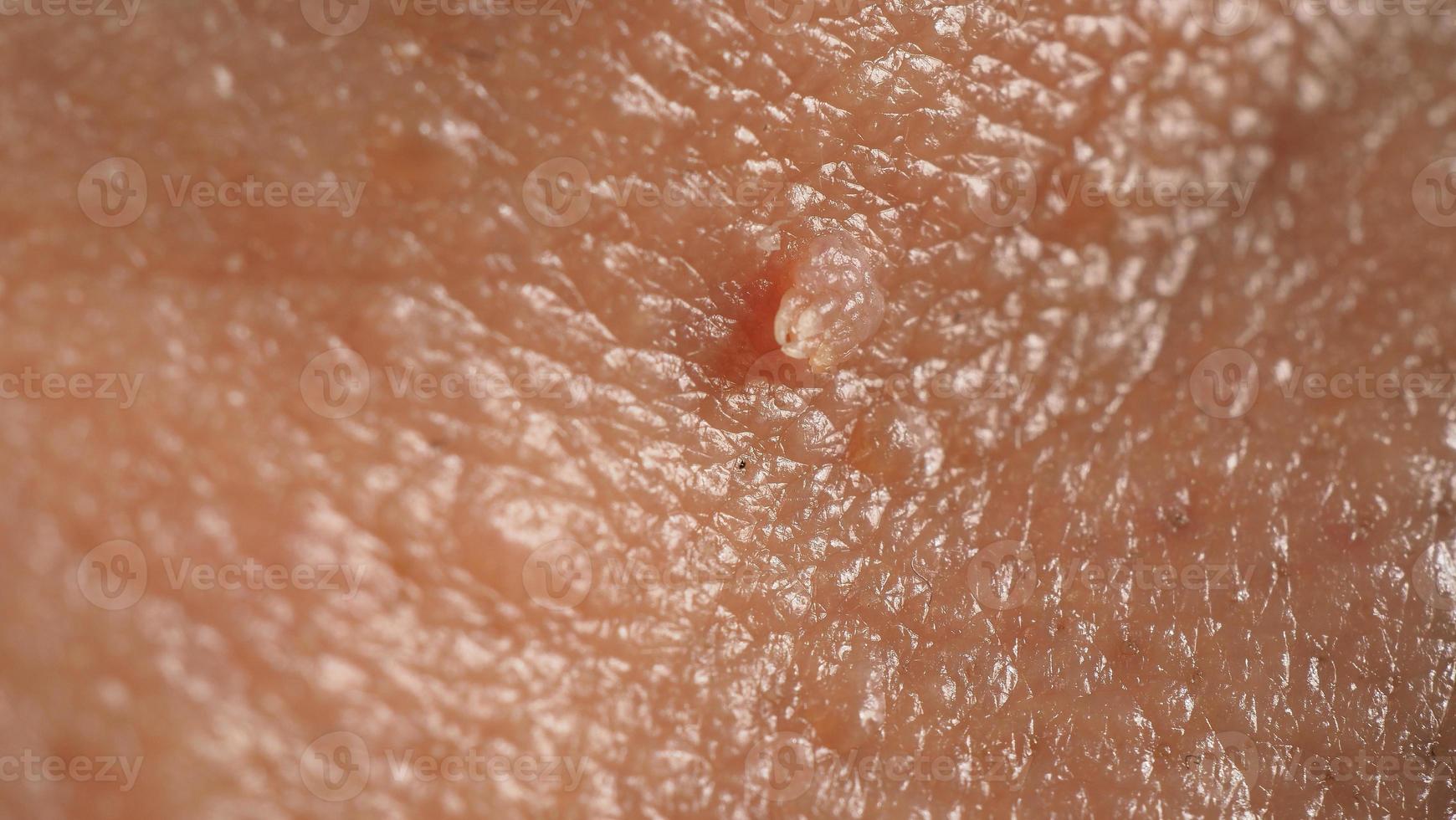 Wart skin removal. Macro shot of warts near eye on face. photo