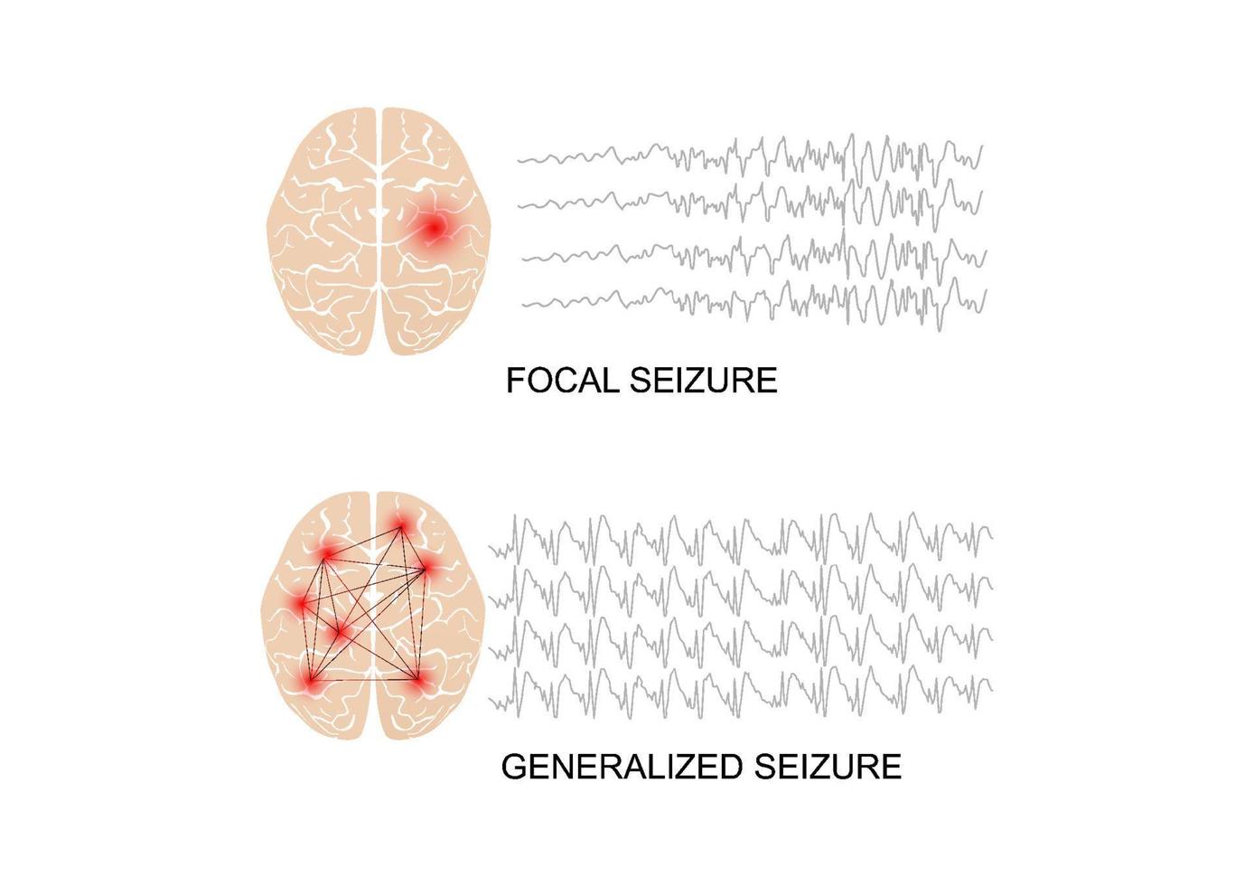 Illustration of seizure types demonstrating by onset and brain waves vector
