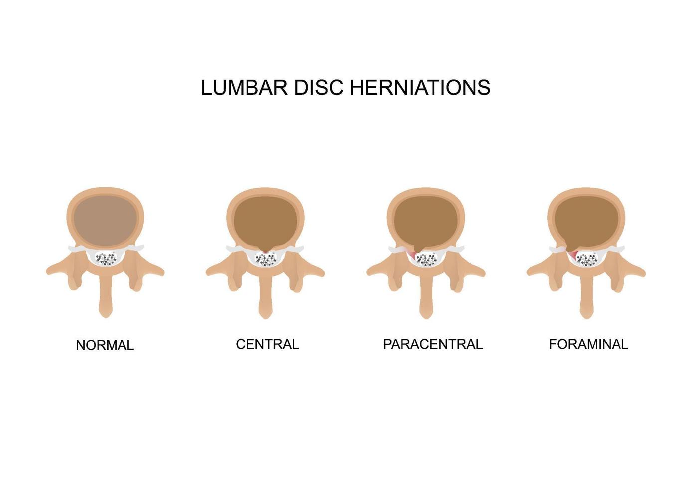 Type of lumbar disc herniations vector