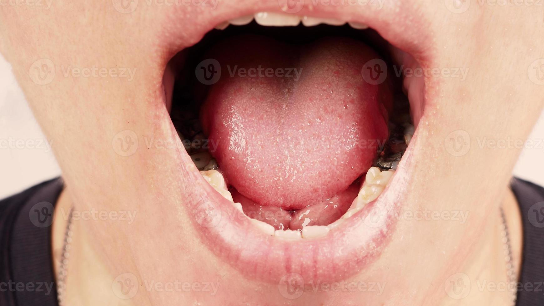 Tratamiento de conductos radiculares de dientes cariados. Diente o caries dental del molar inferior. foto
