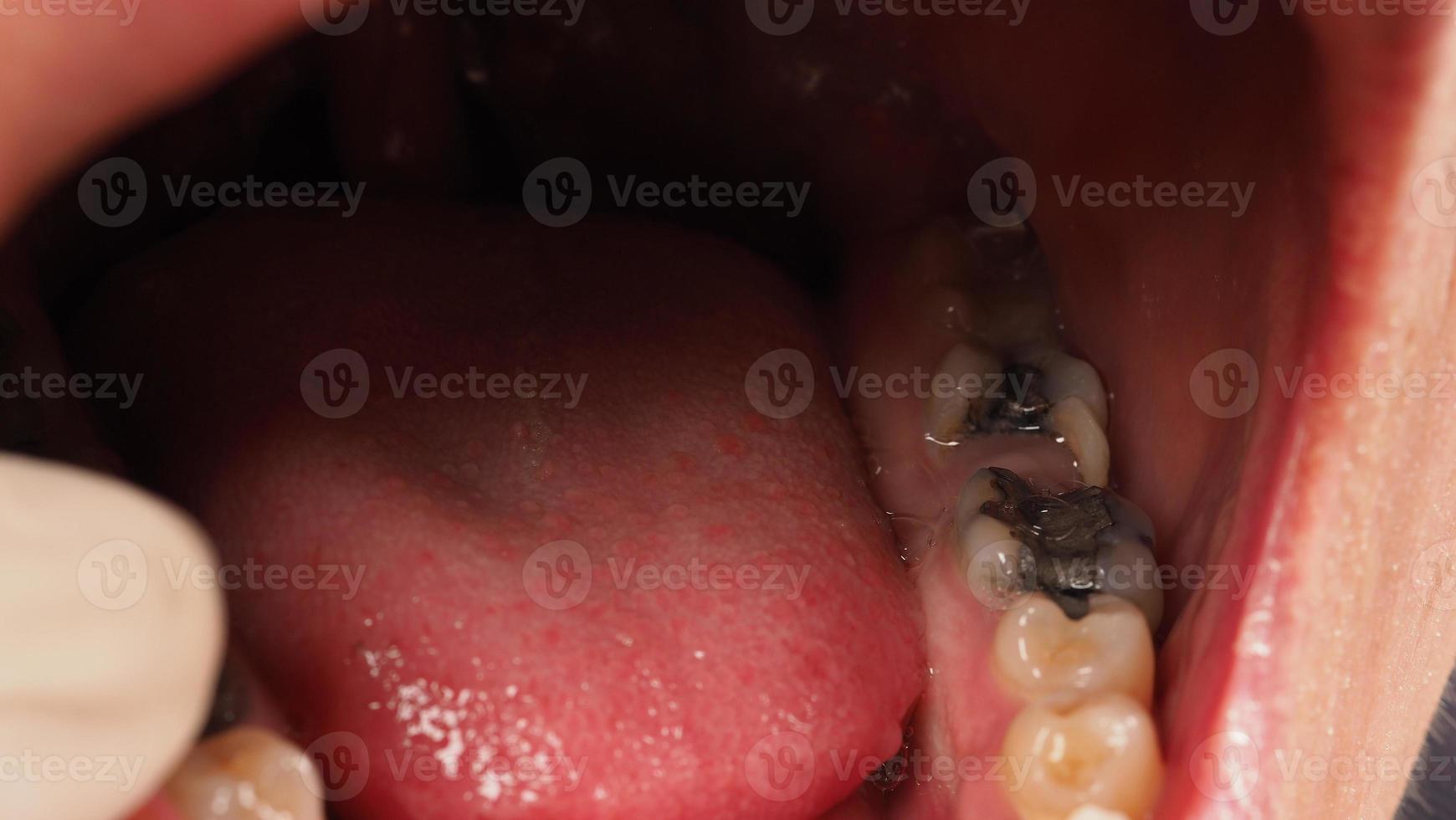 Tratamiento de conductos radiculares de dientes cariados. Diente o caries dental del molar inferior. foto