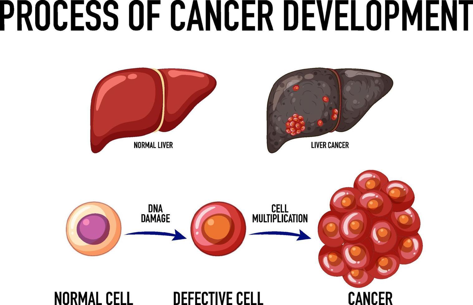 Diagram showing process of cancer development vector