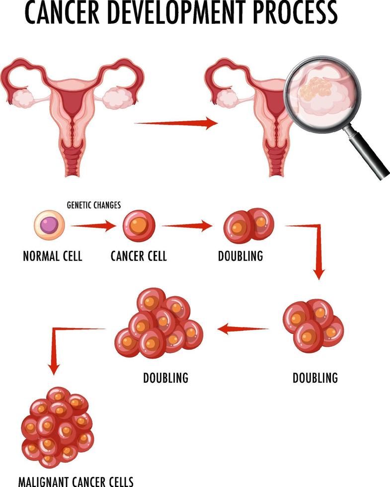 Diagram showing cancer in human ovary vector