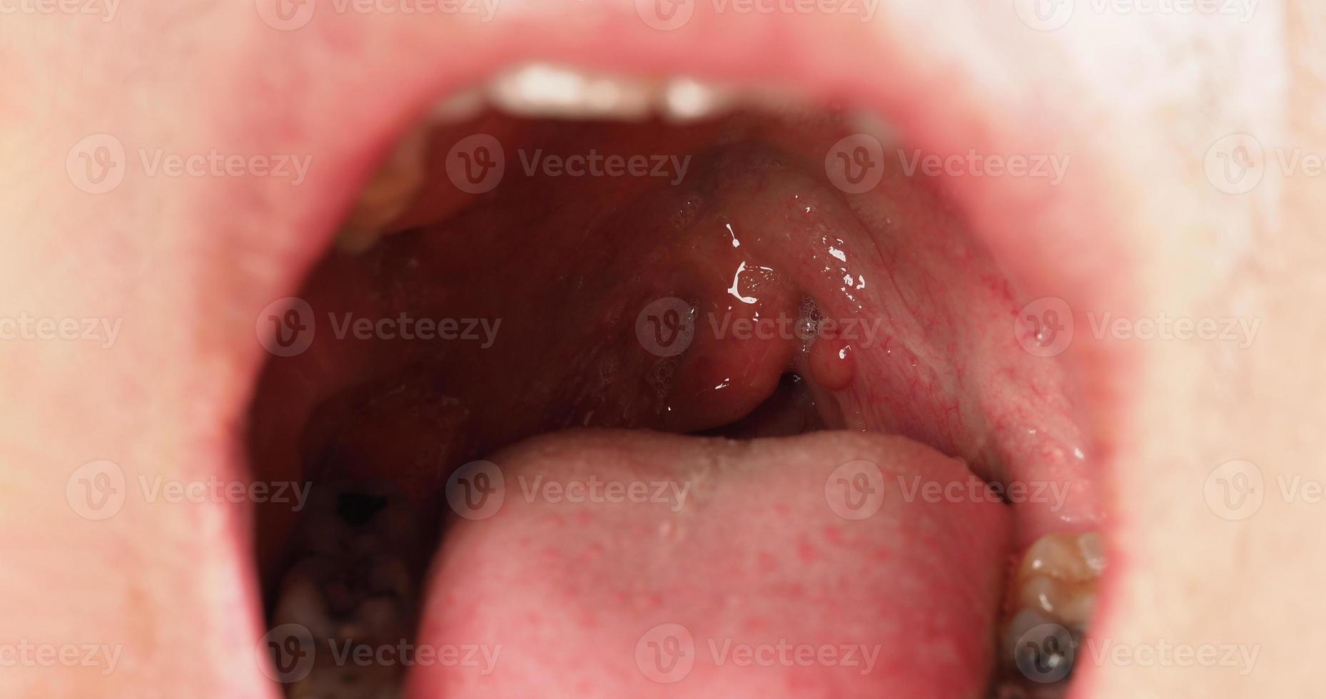 Decayed tooth root canal treatment. Tooth or teeth decay of lower molar. photo