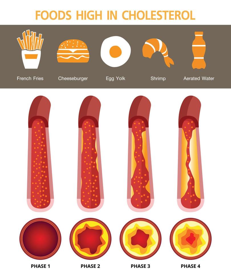 Cholesterol in artery, health risk , vector design, foods high in cholesterol