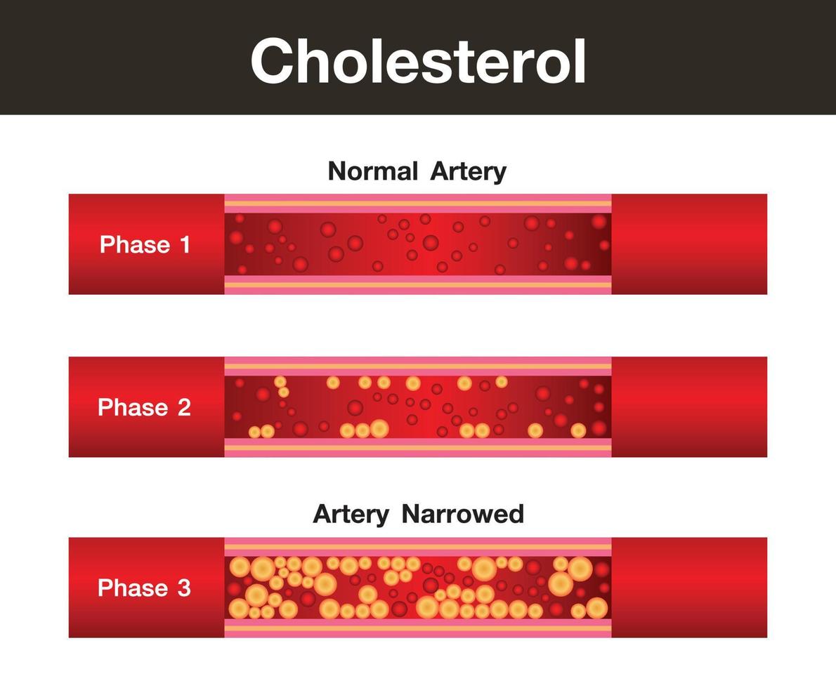 Cholesterol in artery, health risk , vector design