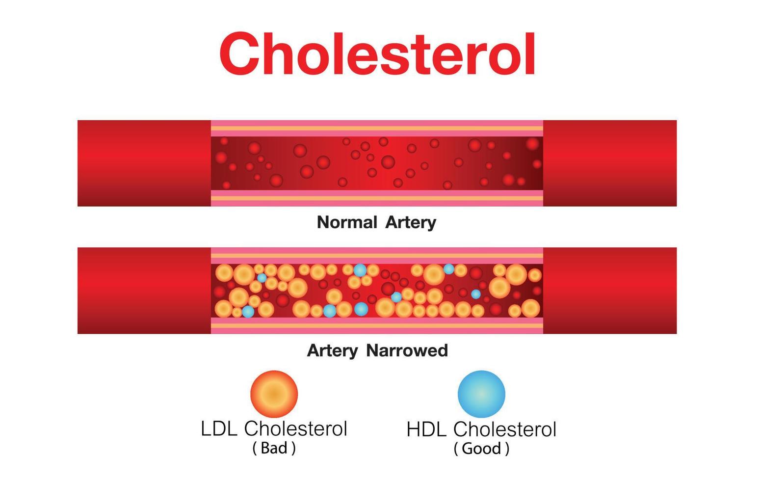 colesterol en la arteria, riesgo para la salud, diseño vectorial vector