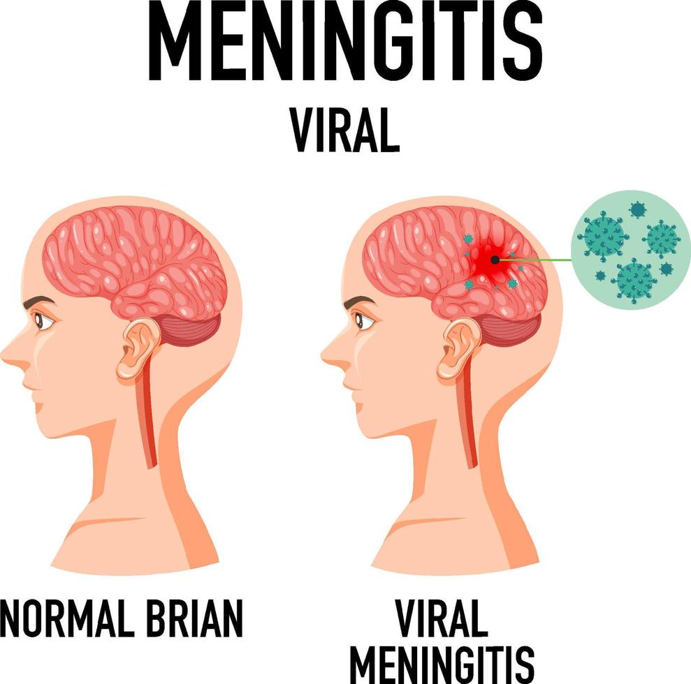 Diagram showing human brain and cancer vector