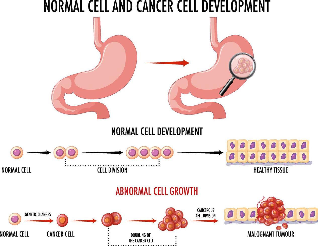 diagrama que muestra el proceso de desarrollo del cáncer vector