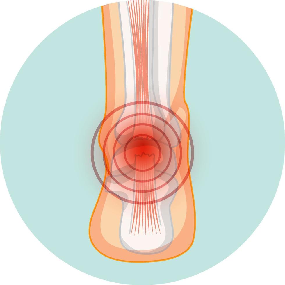 rotura del tendón de Aquiles en plantilla circular vector