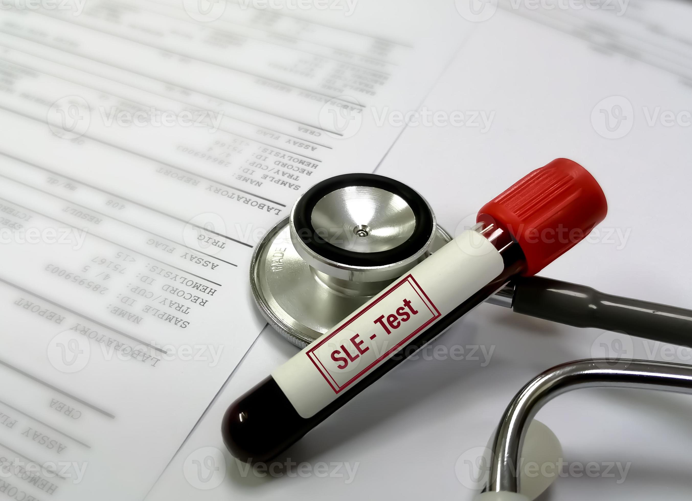 Blood sample for Systemic lupus erythematosus or SLE test. autoimmune