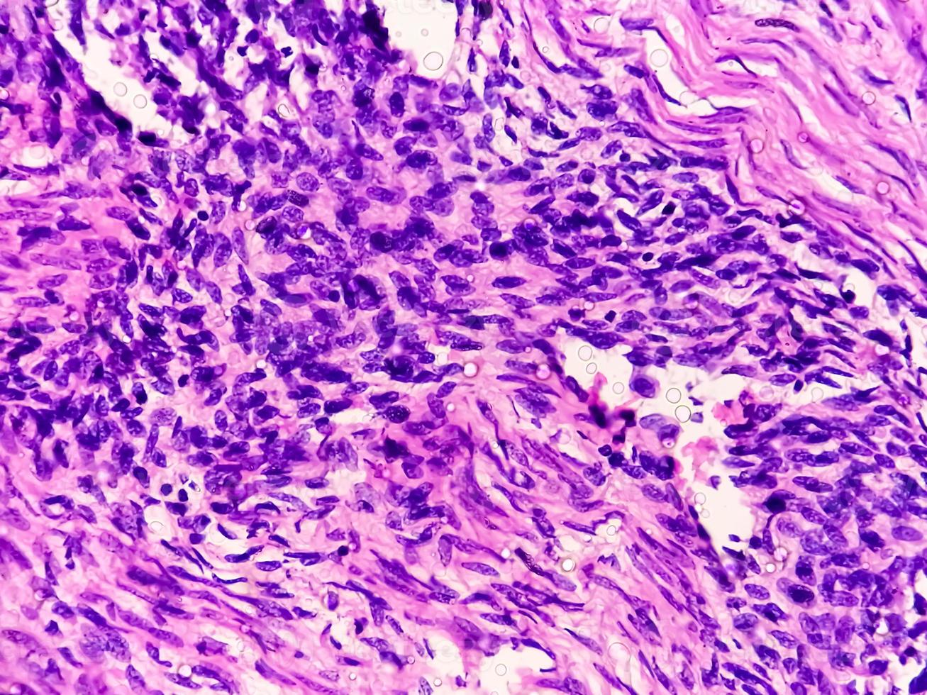 A histological slide of a tissue sample. Close microscopic view. Histopathology. carcinoma. adenocarcinoma photo