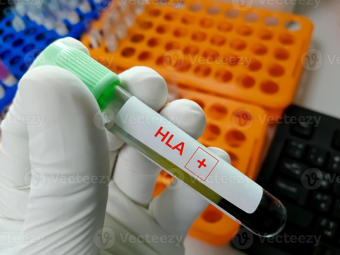 Test tube with blood sample for HLA or Human Leukocyte Antigen test