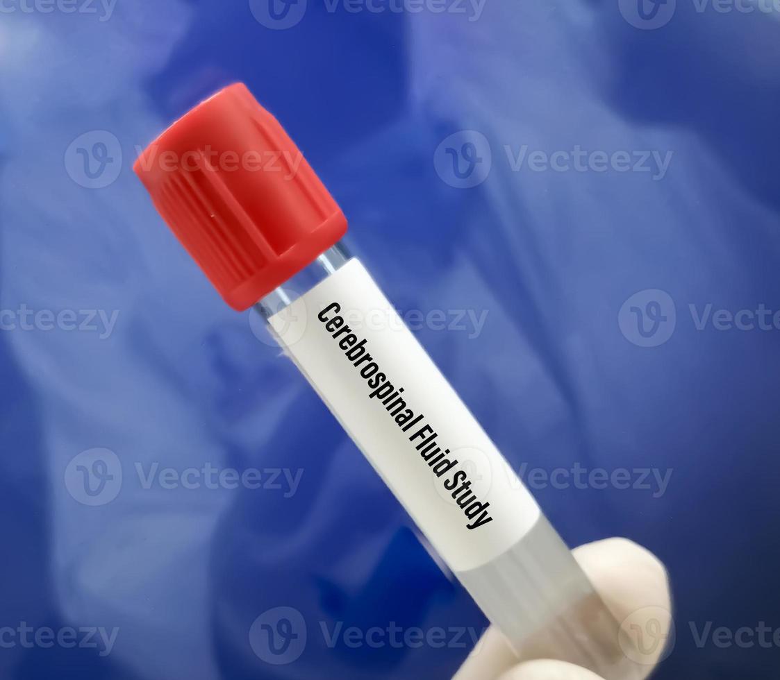 Cerebrospinal fluid or CSF study including biochemistry, cytology, Gram staining. photo