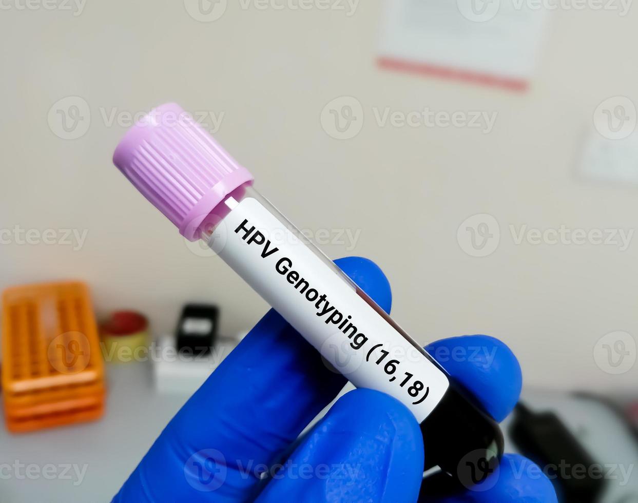Blood sample for Human papillomavirus or HPV genotyping testing in PCR laboratory photo