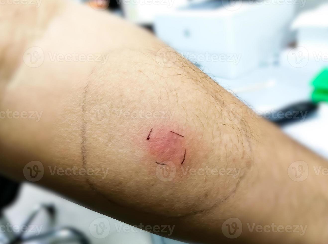 Vacunación mantoux, fotografía de vista de primer plano del brazo del paciente con reacción de mancha roja a la realización de la prueba mantoux. Paciente tuberculocis positivo. foto