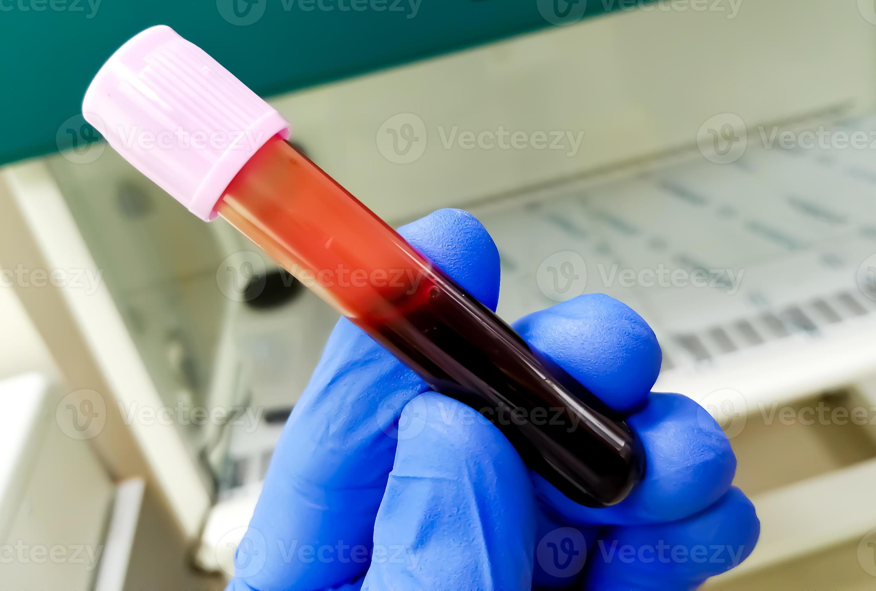 Technician hold lavender tube with blood sample for hematological or Technician hold lavender tube with blood sample for hematological or