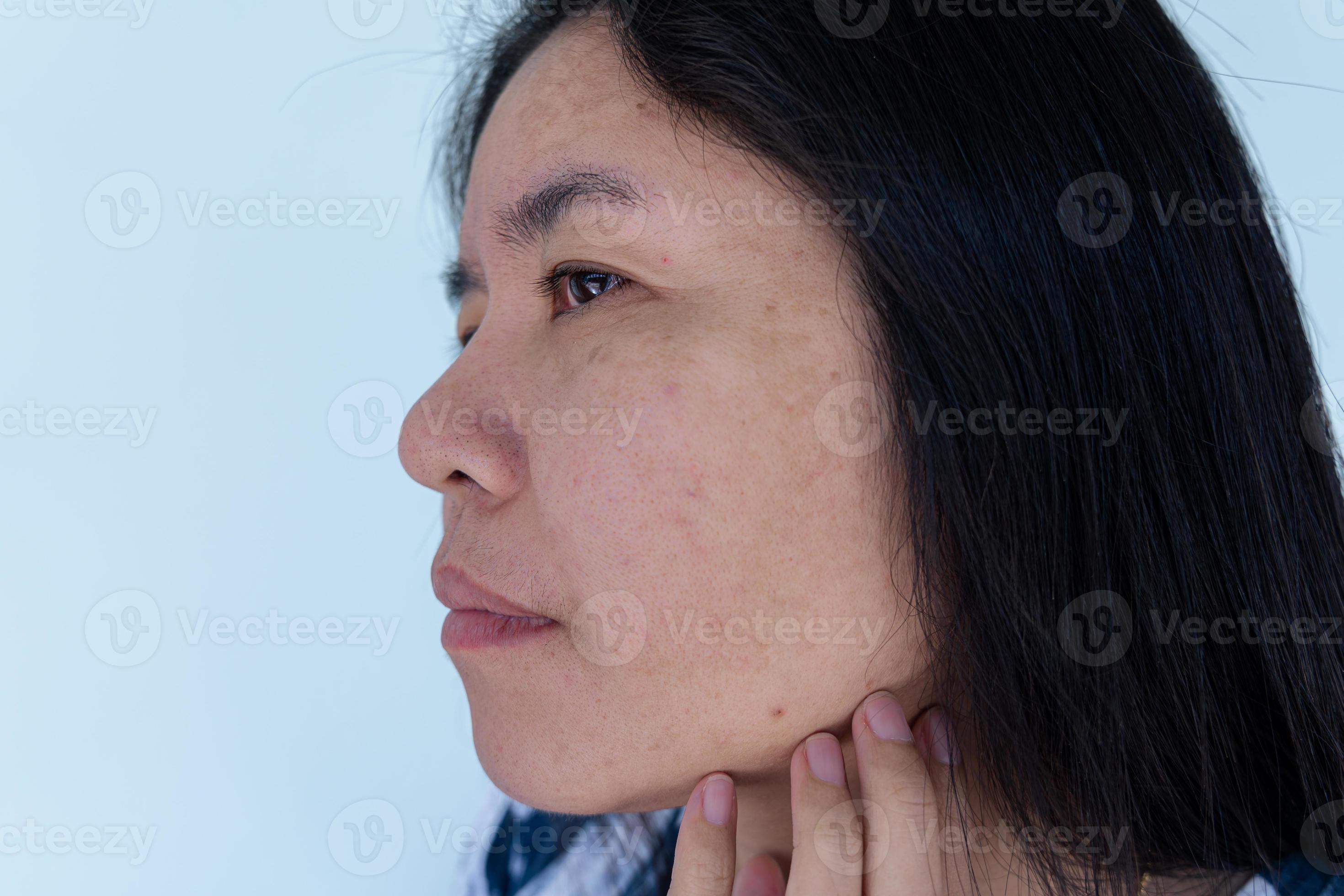 Big Blackhead Pimple - yk0gixy