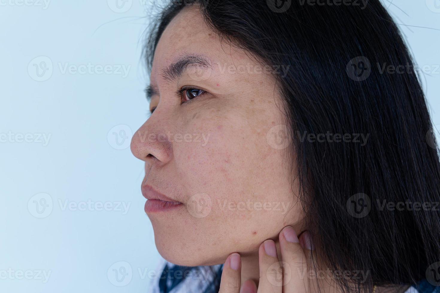 Close up of Asian adult woman face has freckles, large pores, blackhead pimple and scars problem from not take care for a long time. Soft focus of skin problem face. Treatment and Skincare concept photo