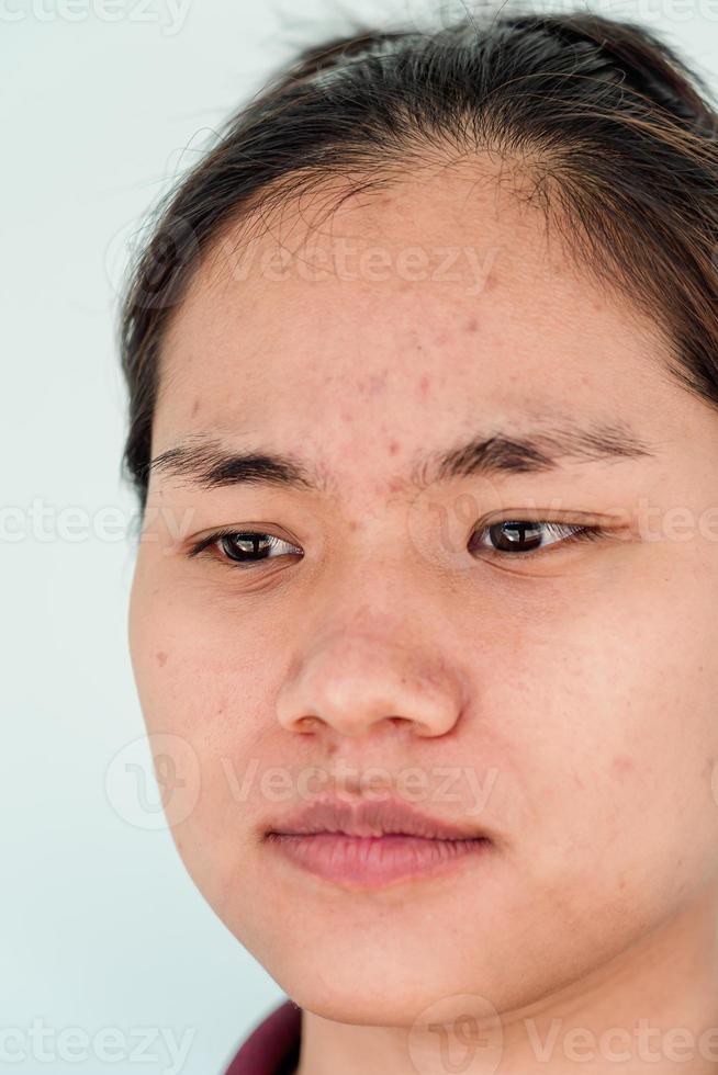 Close up of young Asian woman worry about her face when she has problems with skin on her face. Problems with acne and scar on the female skin. Problem skincare and health concept. photo