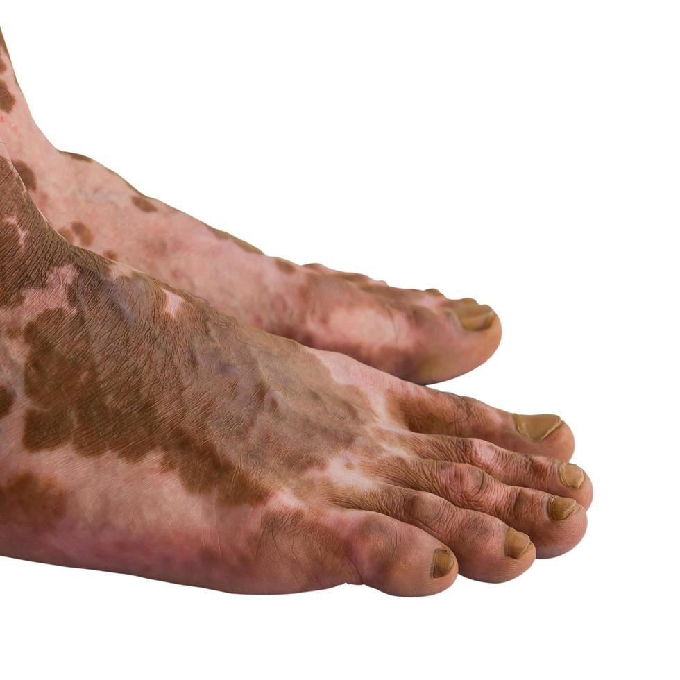 Scars on the feet of men who were burned. photo