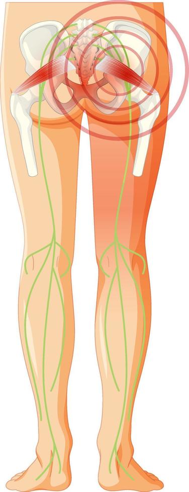 espalda baja que sufre de espondilitis anquilosante vector