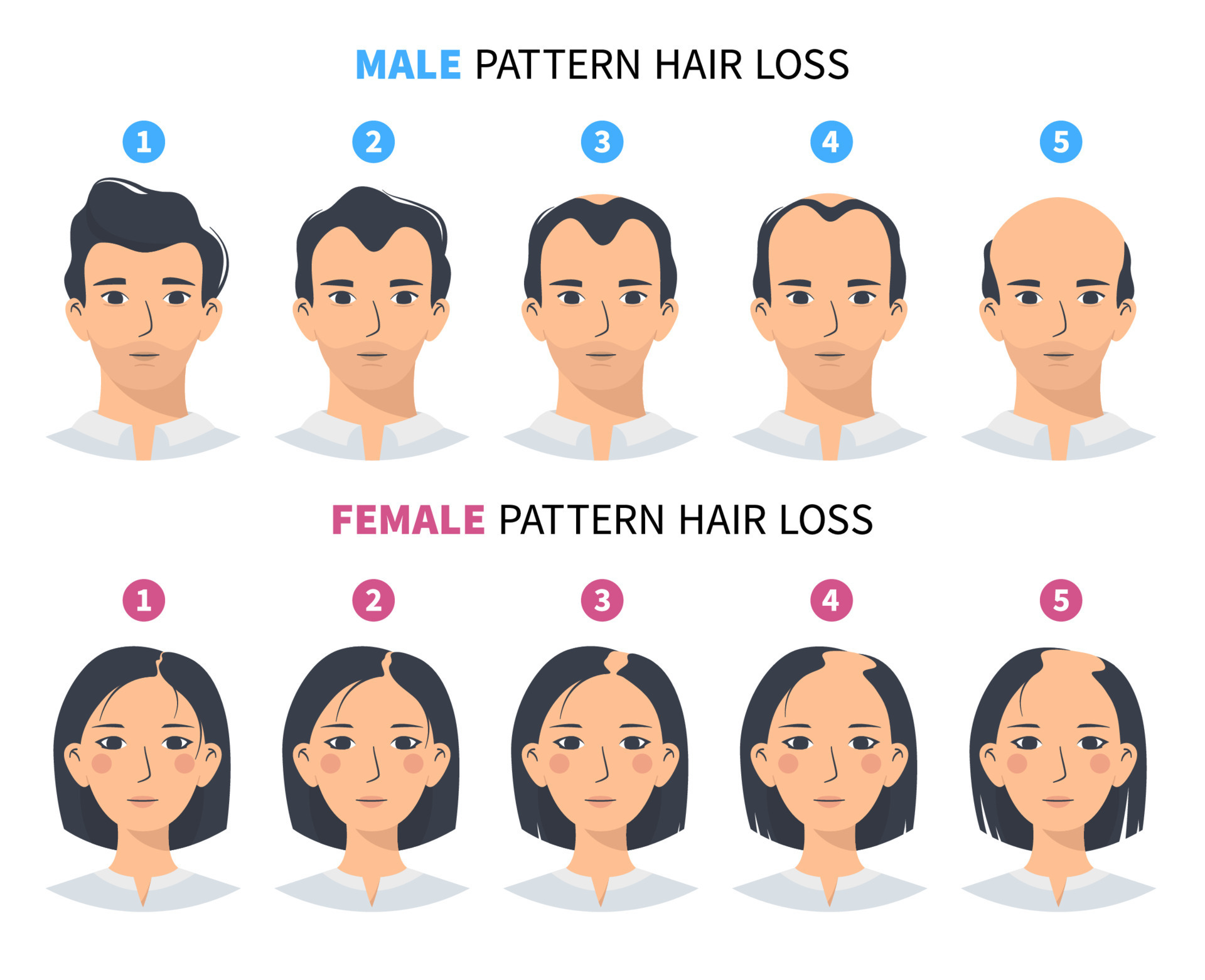 FemalePattern Baldness Causes Treatments and More  GoodRx