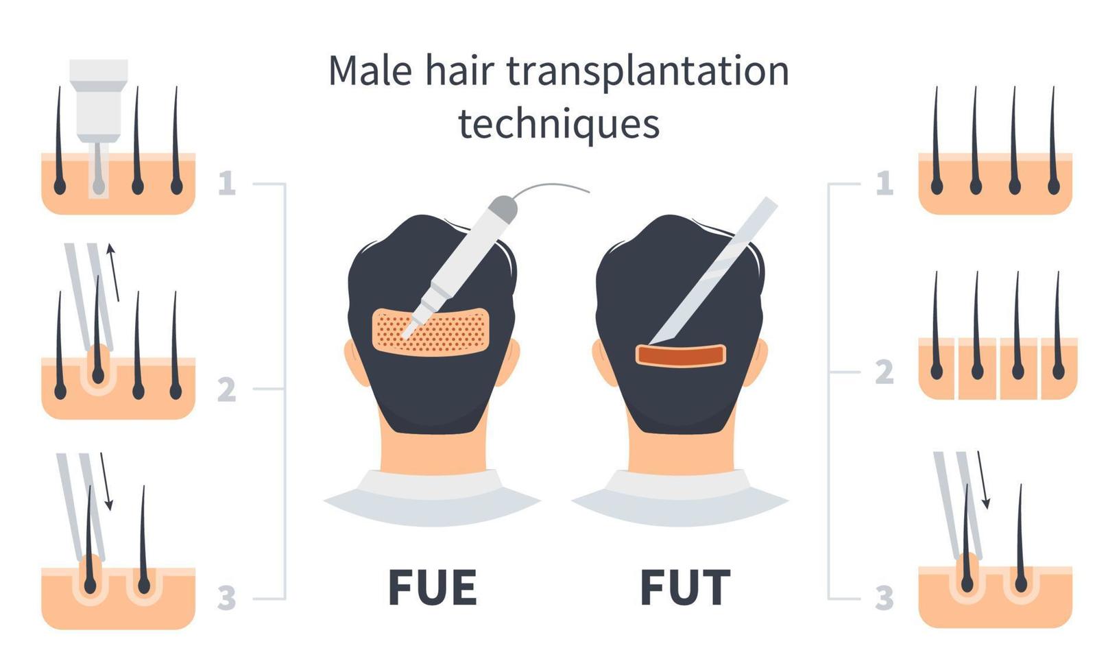 comparación de fue y fut de trasplante de cabello masculino, etapas de extracción de unidades foliculares. tratamiento de la calvicie, alopecia y caída del cabello. infografía médica vectorial, cuero cabelludo de la cabeza del hombre vector