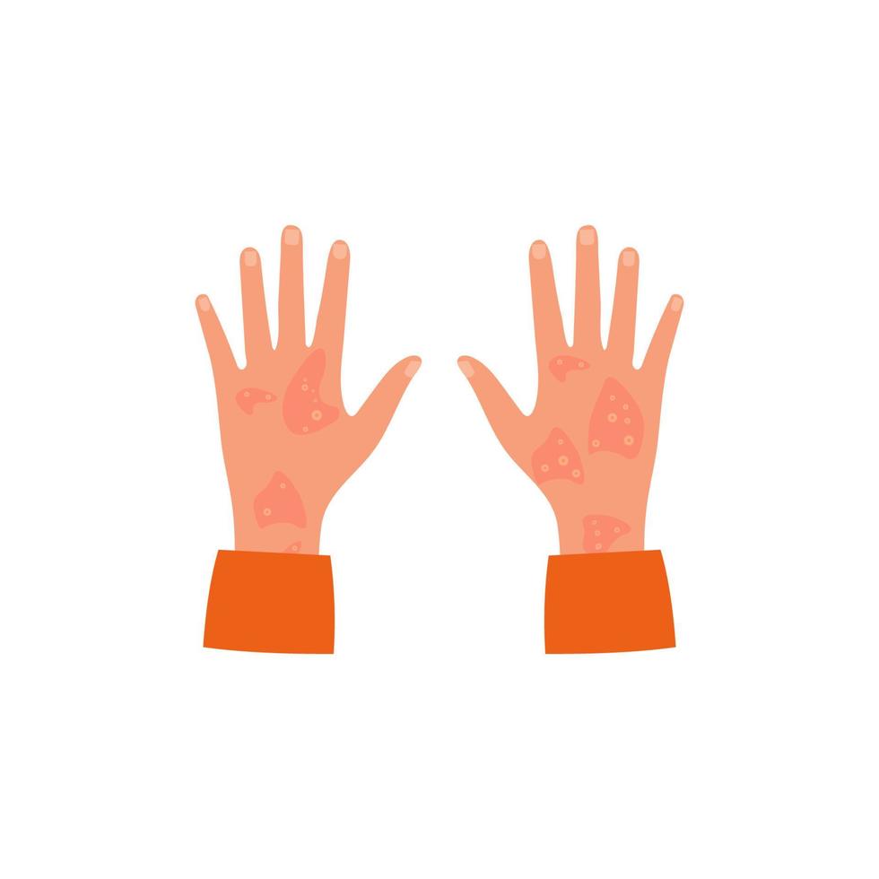 manos con dermatitis atópica, eccema, psoriasis. concepto de problemas de piel. vector. vector