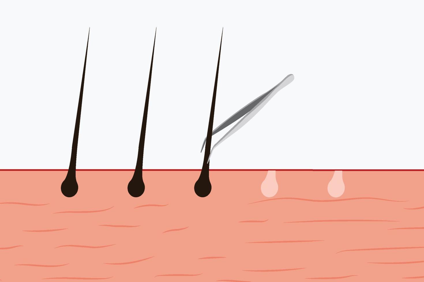 Pulling out body hair with a tweezer vector. Using a tweezer to pull out body hair from the skin. Skin vector illustration with hair and a tweezer. Hair removal concept from the skin.