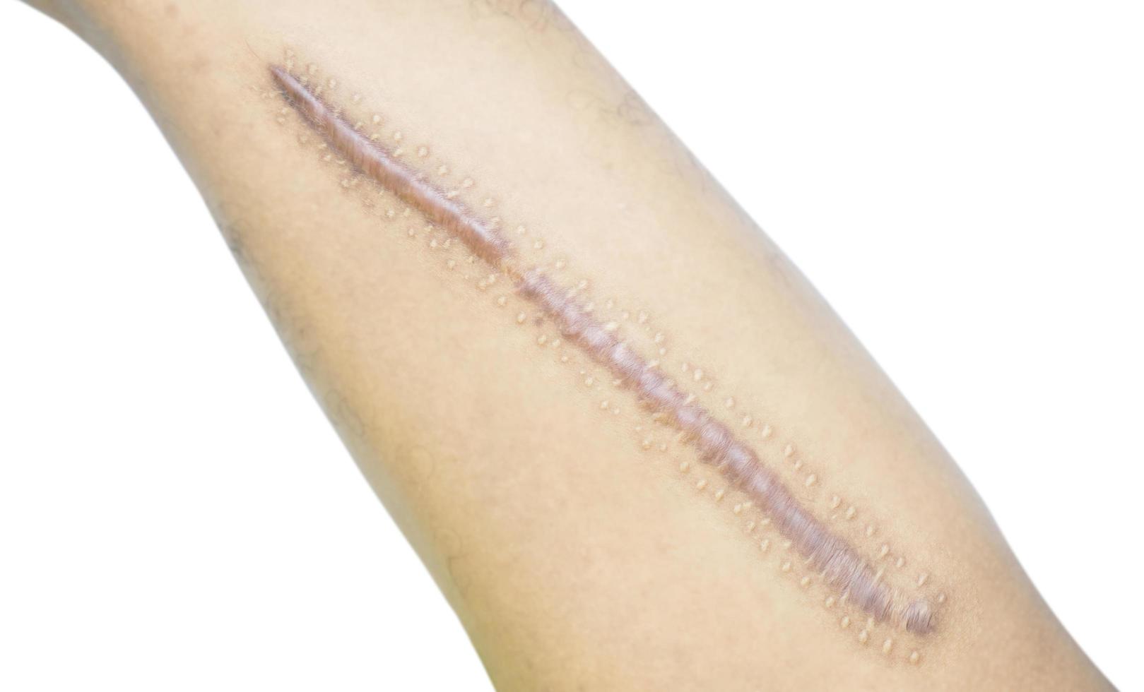 Keloid scar on leg skin. Hypertrophic scar need treatment by laser and surgery for removal scar at skincare cosmetology clinic. Scar from heal tissue injury from body accident. Dermatology technology. photo