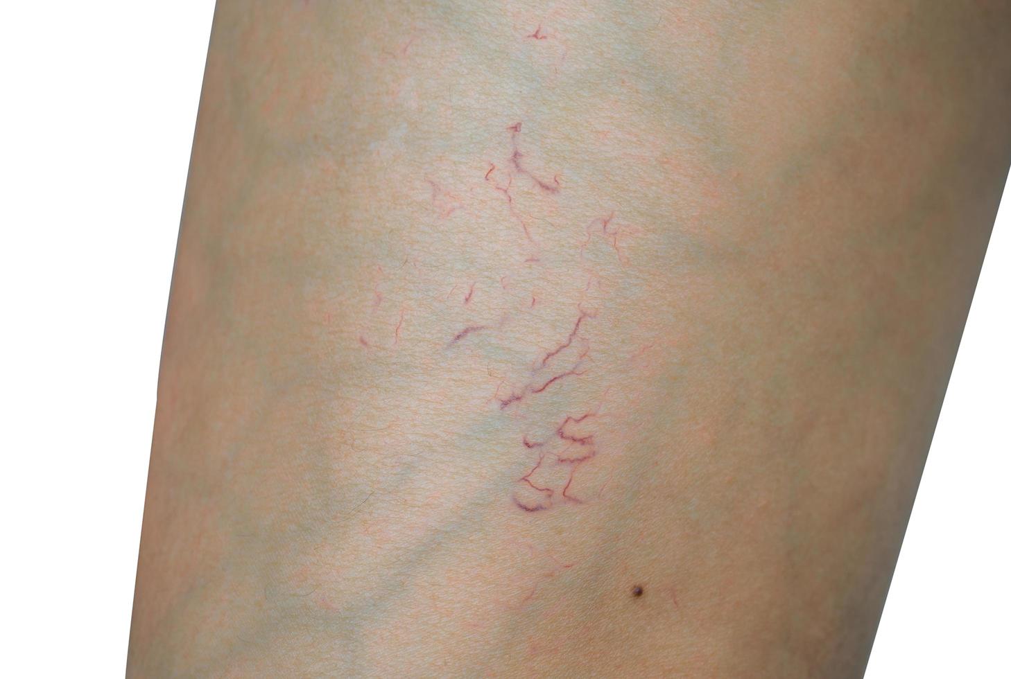 Macro shot of spider veins on woman leg skin on white background. Concept before sclerotherapy or laser surgery to remove spider veins. Spider veins need to use compression stockings. photo