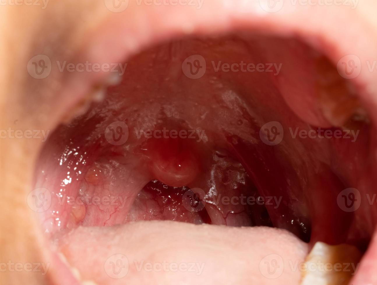 dolor de garganta con garganta hinchada. cierre la boca abierta con hinchazón de la pared faríngea posterior y úvula y amígdalas. folículos gripales en la pared faríngea posterior. tracto respiratorio superior. foto