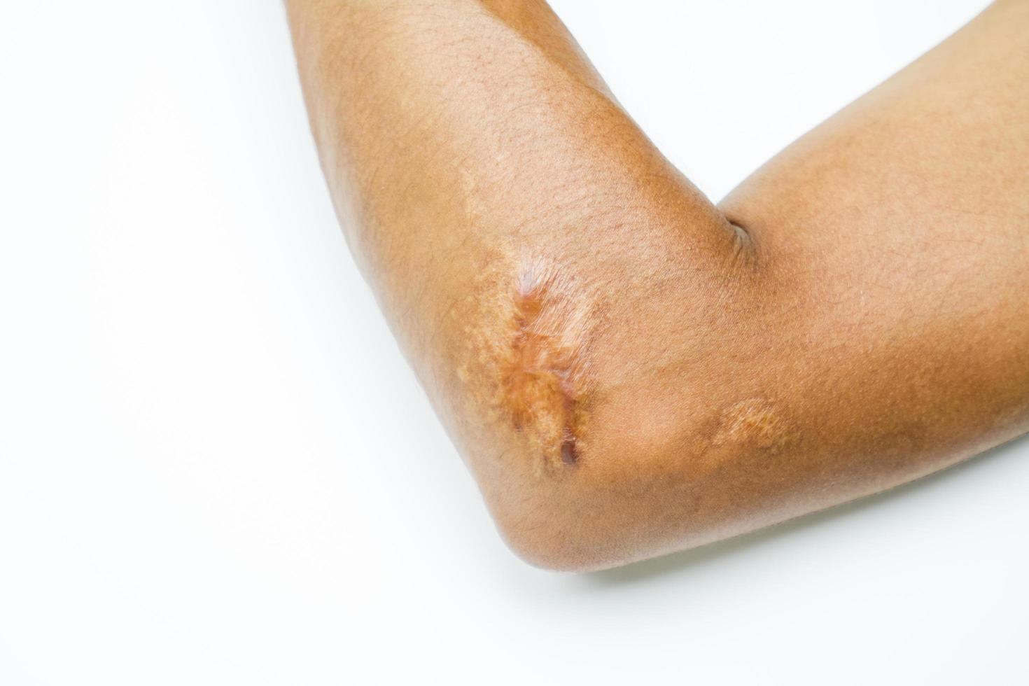 Keloid scar on elbow skin. Hypertrophic scar treatment by laser and surgery for removal keloid at skincare cosmetology clinic. Scar from heal tissue injury from body accident. Dermatology technology. photo